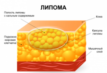 Причины появления и лечение липом