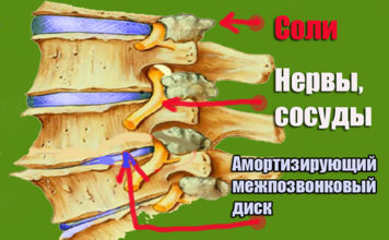Что такое отложение солей в позвоночнике. Чем они опасны? Что такое отложение солей в позвоночнике. Чем они опасны?